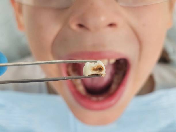 Best Emergency Tooth Extraction in Garwood, NJ
